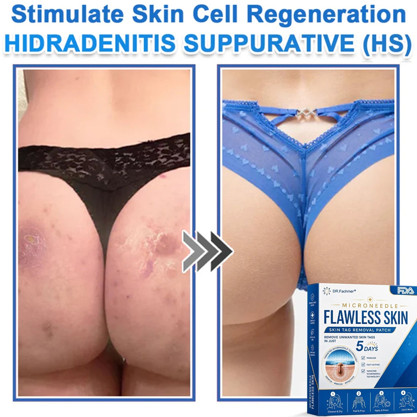 ✅ DR.Fachmer® 2-in-1 Microneedle & Hydrocolloid Patch | Raised Moles,Acne,  Flat Warts & Skin Tags Remover | Improves Wrinkles, Scars & Blemishes | Invisible Pimple Patches for Face & Body