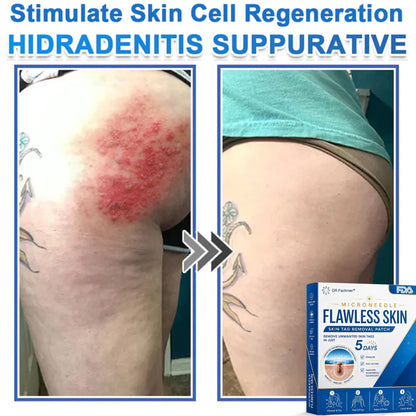 ✅ DR.Fachmer® 2-in-1 Microneedle & Hydrocolloid Patch | Raised Moles,Acne,  Flat Warts & Skin Tags Remover | Improves Wrinkles, Scars & Blemishes | Invisible Pimple Patches for Face & Body