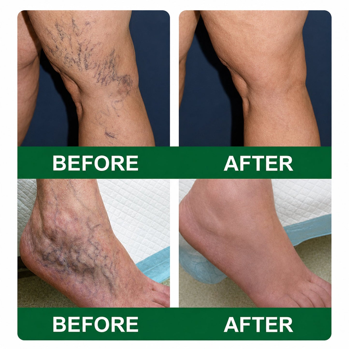 🌿DR.Fachmer® Vein Ease Microneedle Care Patch (For Spider Veins, Varicose Veins, Swelling & Leg Fatigue) - Last Day Promotion 50% OFF