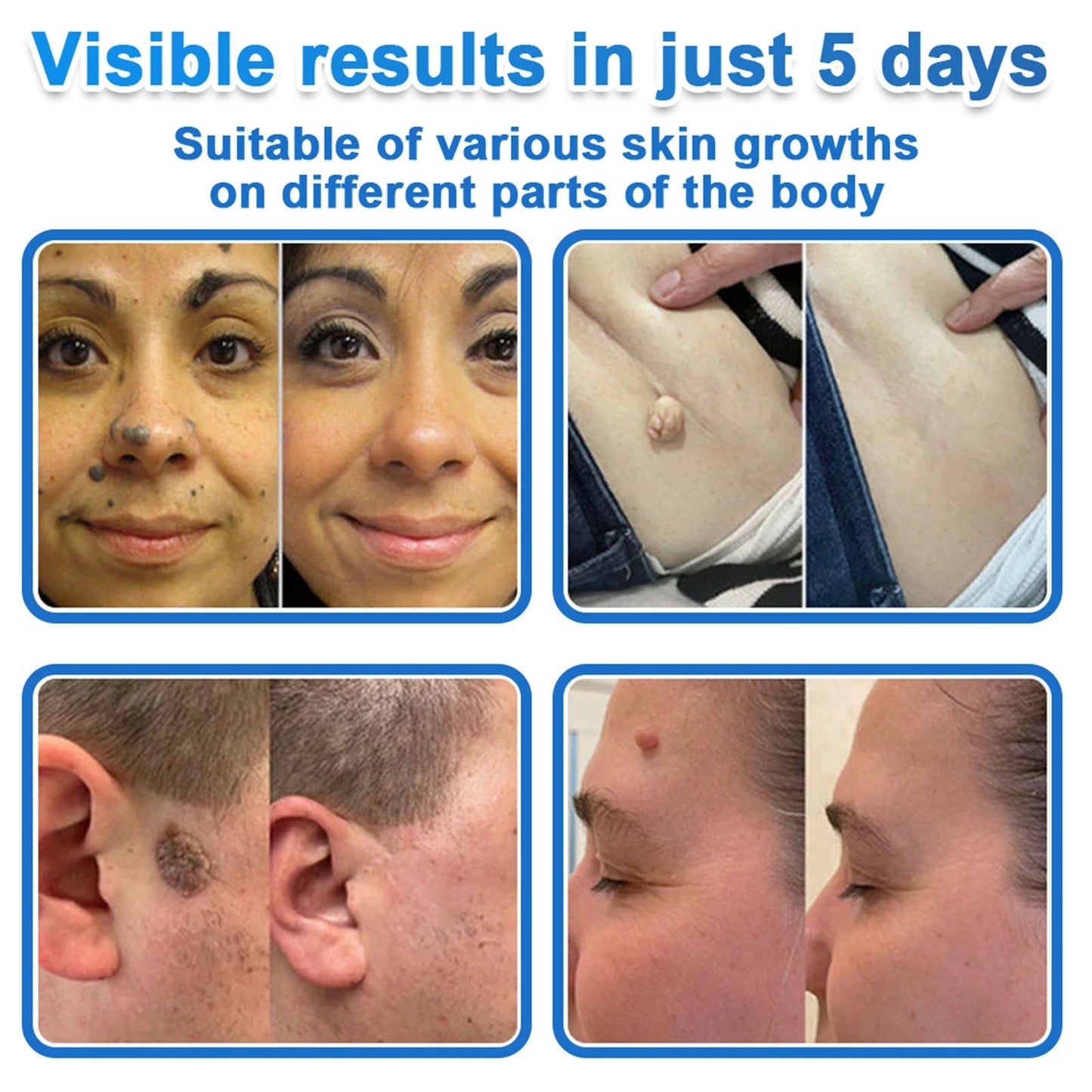 ✅ DR.Fachmer® 2-in-1 Microneedle & Hydrocolloid Patch | Raised Moles,Acne,  Flat Warts & Skin Tags Remover | Improves Wrinkles, Scars & Blemishes | Invisible Pimple Patches for Face & Body