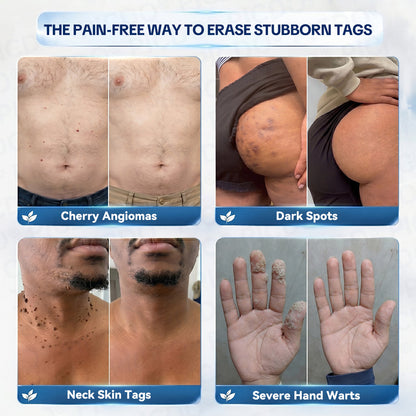 GFOUK® 7-𝐃𝐚𝐲 𝐒𝐤𝐢𝐧 𝐓𝐚𝐠 & 𝐒𝐩𝐨𝐭 𝐄𝐫𝐚𝐬𝐞𝐫 𝐂𝐫𝐞𝐚𝐦 (Zero Pain, Zero 𝐒𝐜𝐚𝐫𝐬 Formula) 🌹