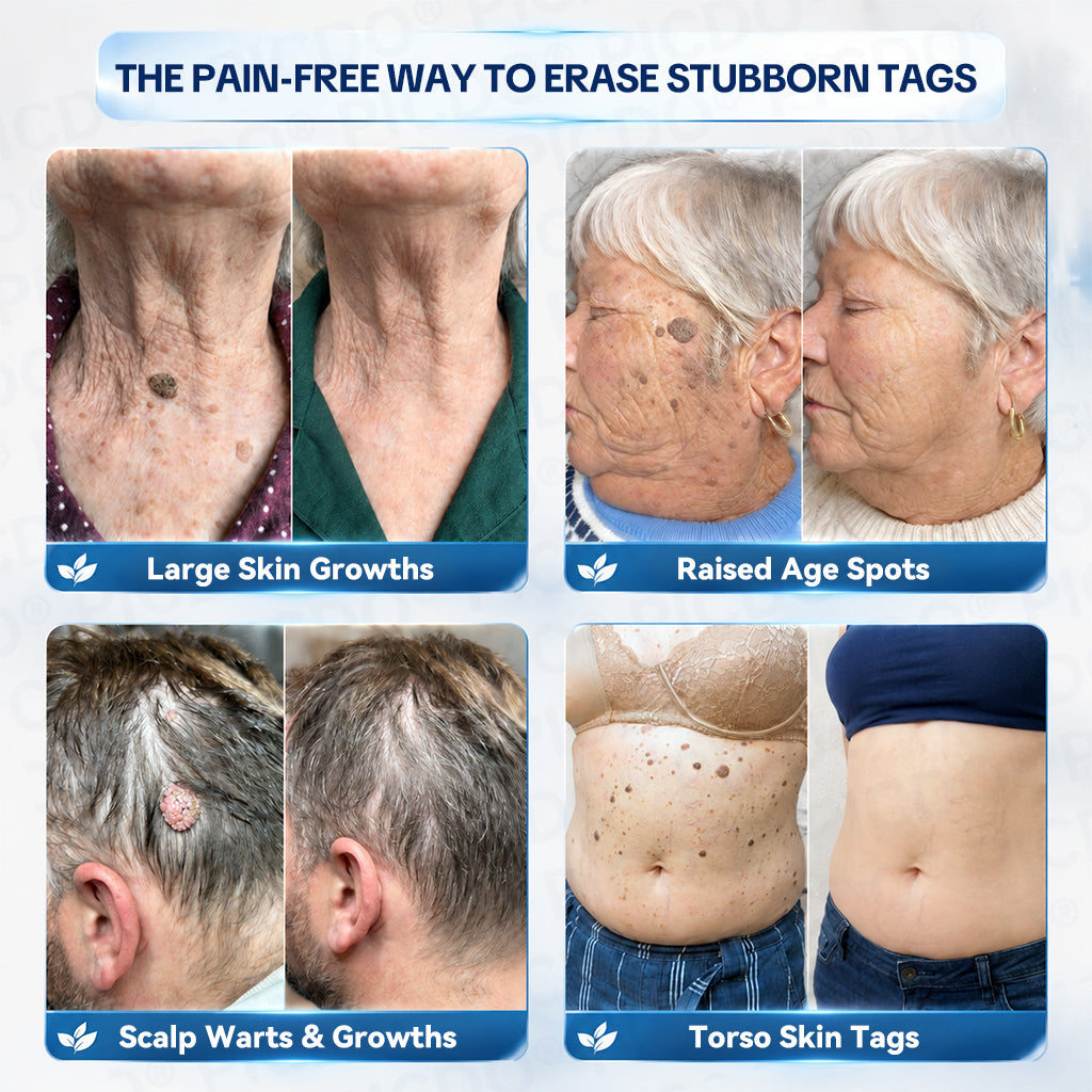 GFOUK® 7-𝐃𝐚𝐲 𝐒𝐤𝐢𝐧 𝐓𝐚𝐠 & 𝐒𝐩𝐨𝐭 𝐄𝐫𝐚𝐬𝐞𝐫 𝐂𝐫𝐞𝐚𝐦 (Zero Pain, Zero 𝐒𝐜𝐚𝐫𝐬 Formula) 🌹