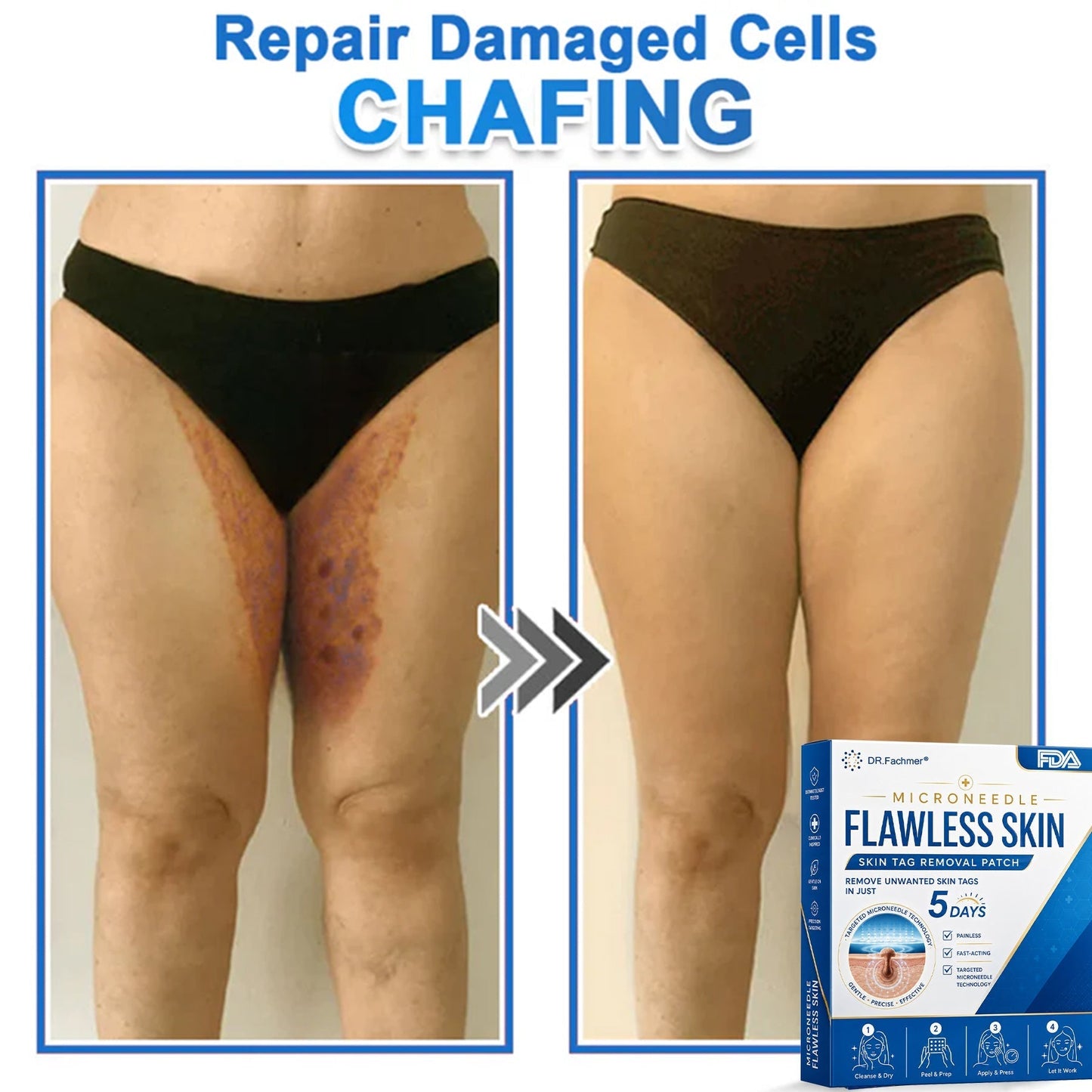 ✅ DR.Fachmer® 2-in-1 Microneedle & Hydrocolloid Patch | Raised Moles,Acne,  Flat Warts & Skin Tags Remover | Improves Wrinkles, Scars & Blemishes | Invisible Pimple Patches for Face & Body