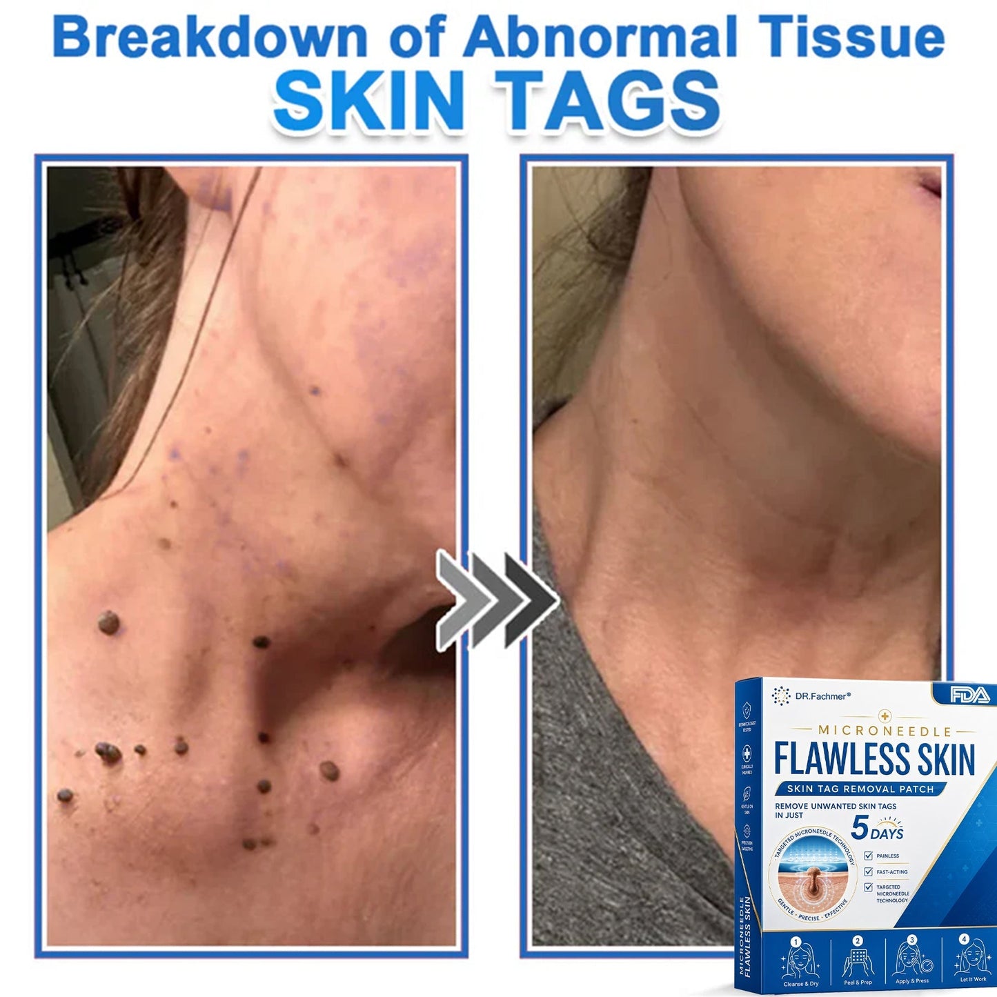 ✅ DR.Fachmer® 2-in-1 Microneedle & Hydrocolloid Patch | Raised Moles,Acne,  Flat Warts & Skin Tags Remover | Improves Wrinkles, Scars & Blemishes | Invisible Pimple Patches for Face & Body
