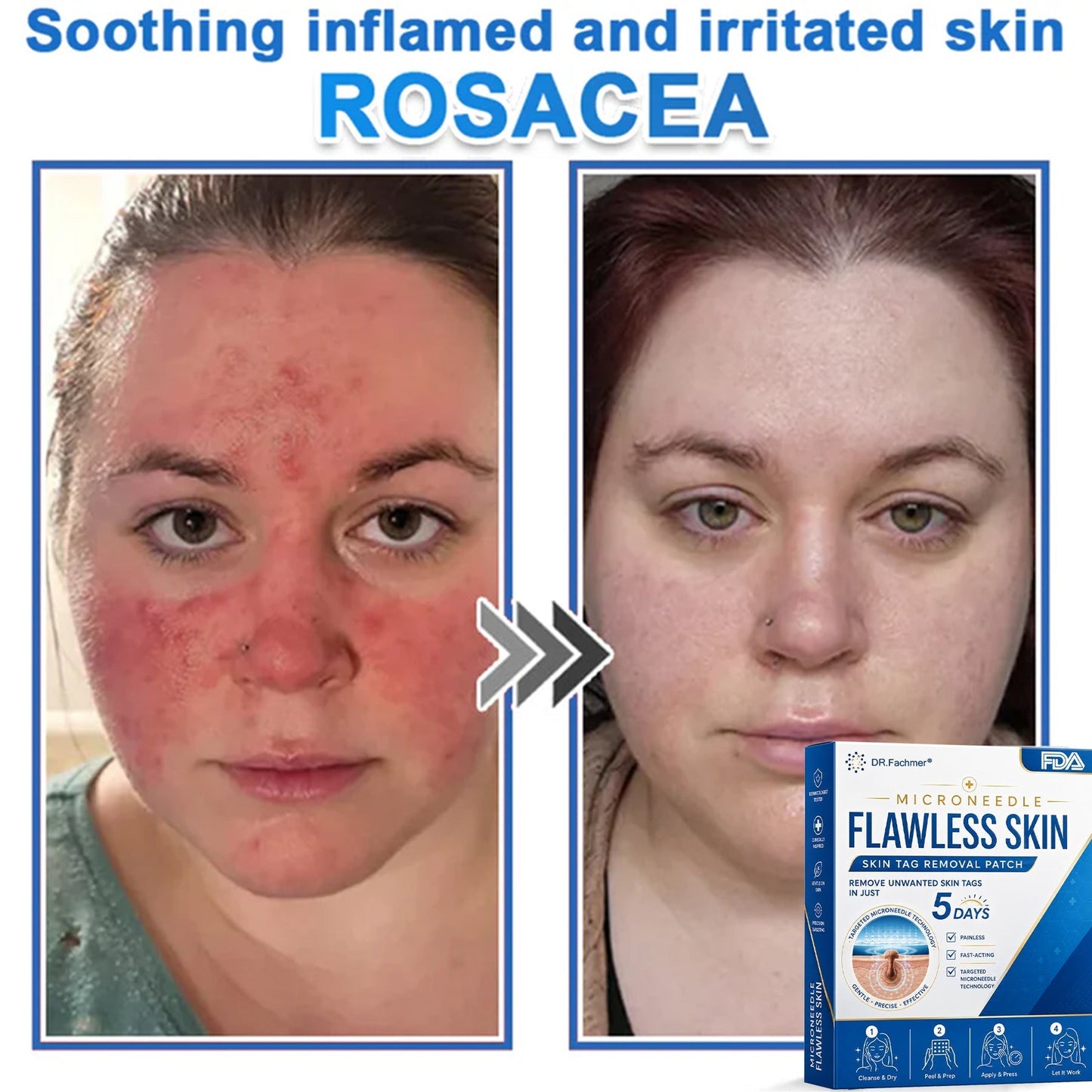 ✅ DR.Fachmer® 2-in-1 Microneedle & Hydrocolloid Patch | Raised Moles,Acne,  Flat Warts & Skin Tags Remover | Improves Wrinkles, Scars & Blemishes | Invisible Pimple Patches for Face & Body
