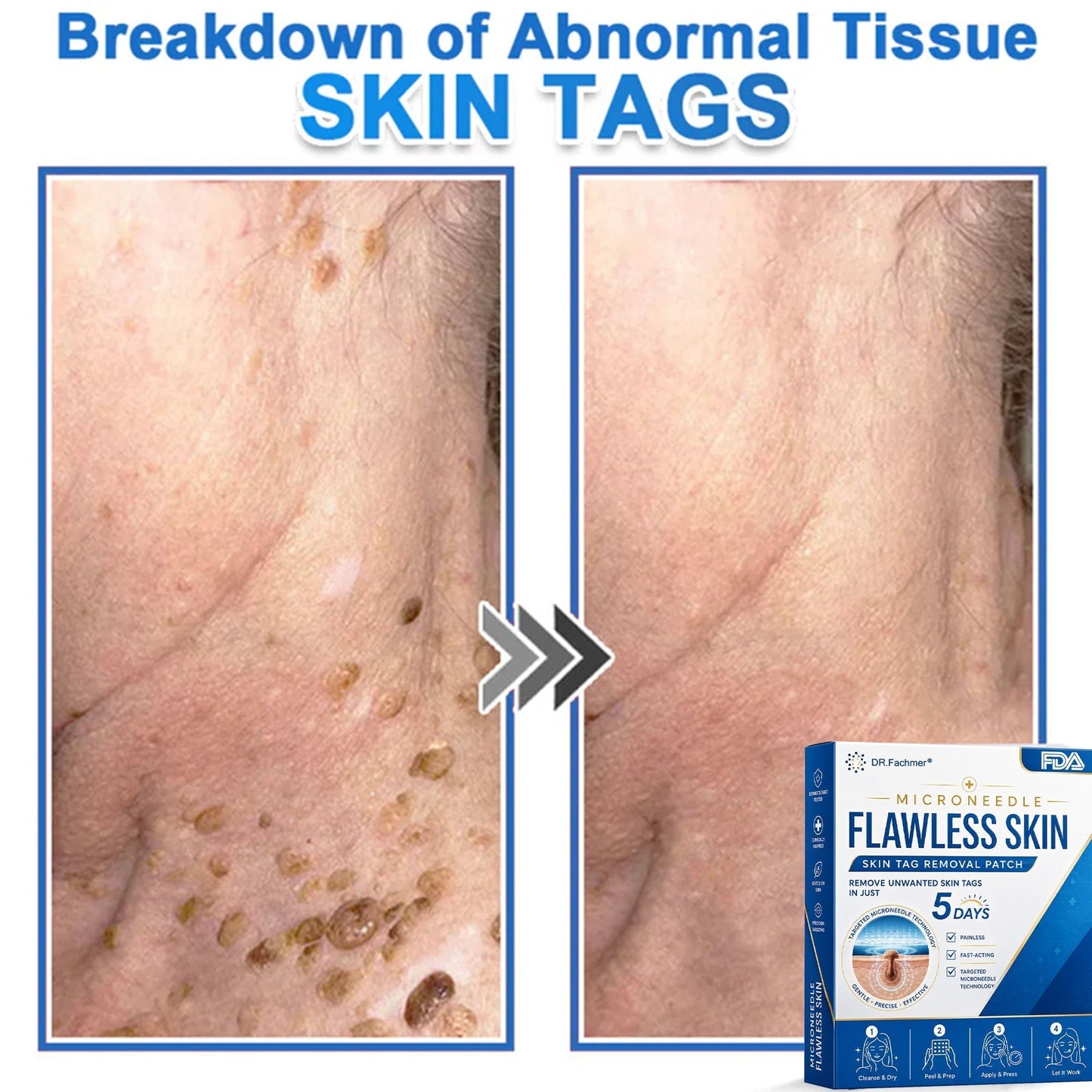 ✅ DR.Fachmer® 2-in-1 Microneedle & Hydrocolloid Patch | Raised Moles,Acne,  Flat Warts & Skin Tags Remover | Improves Wrinkles, Scars & Blemishes | Invisible Pimple Patches for Face & Body