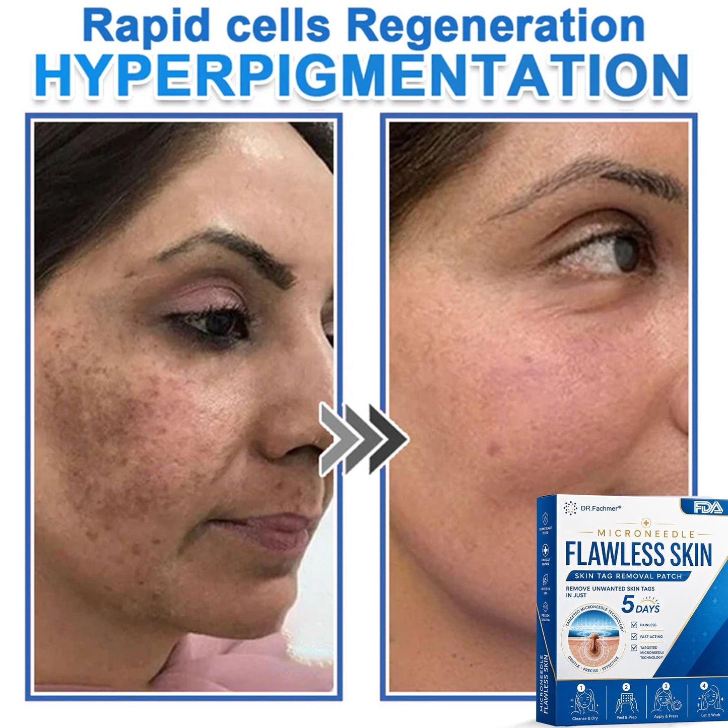 ✅ DR.Fachmer® 2-in-1 Microneedle & Hydrocolloid Patch | Raised Moles,Acne,  Flat Warts & Skin Tags Remover | Improves Wrinkles, Scars & Blemishes | Invisible Pimple Patches for Face & Body